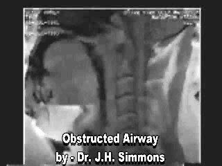 obstructed airway